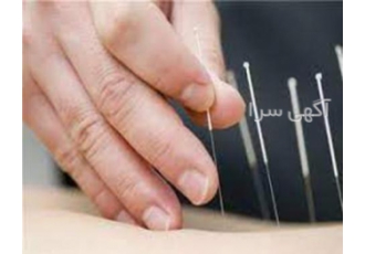 کلاس فشرده 4 روزه طب سوزنی در کرج کلاس فشرده 4 روزه طب سوزنی در کرج