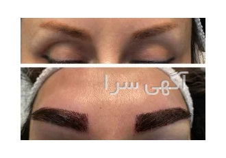 کاشت مو ابرو وریش کلینیک زیبایی پوست و مو دانیان ارائه دهنده ی انواع