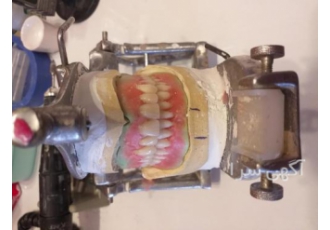 قالب گیری و ساخت دندان مصنوعی پروتز دنچر در منزل