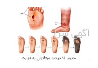 زخم پای دیابتی چگونه بوجود می آید ؟ در تهران در طی 20 سال اخیر افزایش