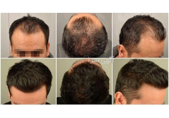 کاشت مو تهرانی کاشت مو تهرانی